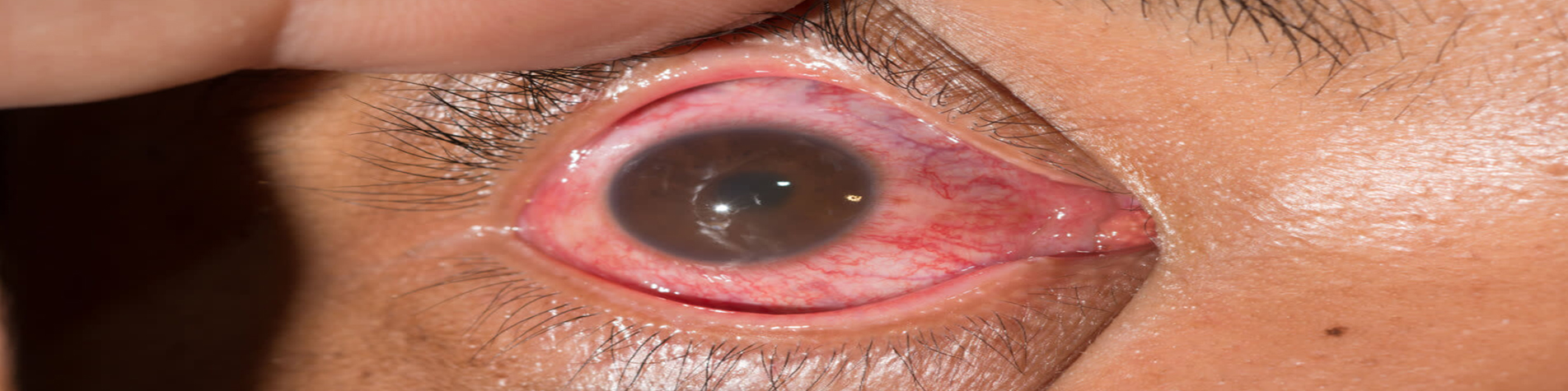 Uvea & Ocular Inflammation